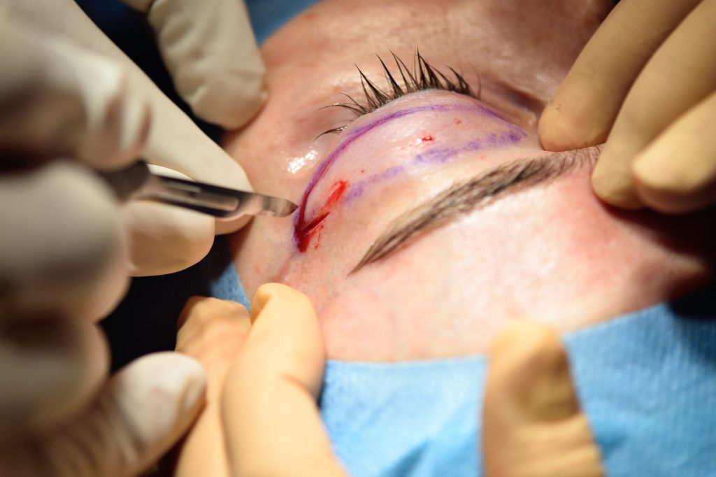 Schönheitsoperationstourismus belastet Schweizer Gesundheitssystem